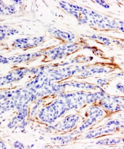 ihcDirect Podoplanin IHC stain, frozen breast tissue, DAB chromogen