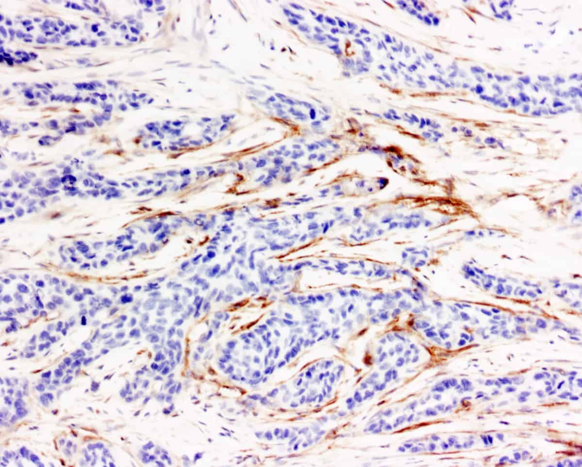 ihcDirect Podoplanin IHC stain, frozen breast tissue, DAB chromogen - Novodiax ihcDirect Podoplanin IHC stain, frozen breast tissue, DAB chromogen