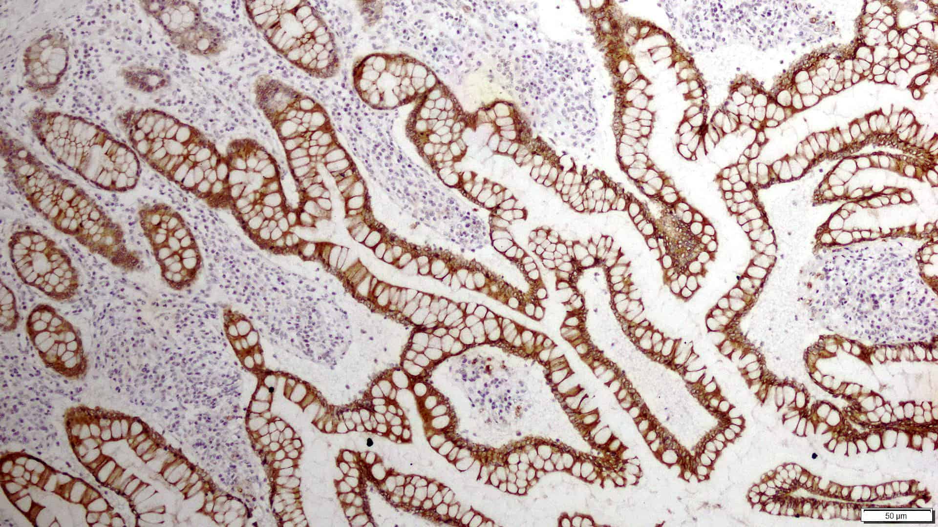 Цитокератин. Cytokeratin Pan. Высокомолекулярные цитокератины. Цитокератины эпителий\.