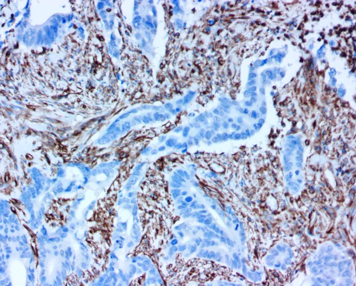 ihcDirect Vimentin IHC stain, colon tissue, DAB chromogen