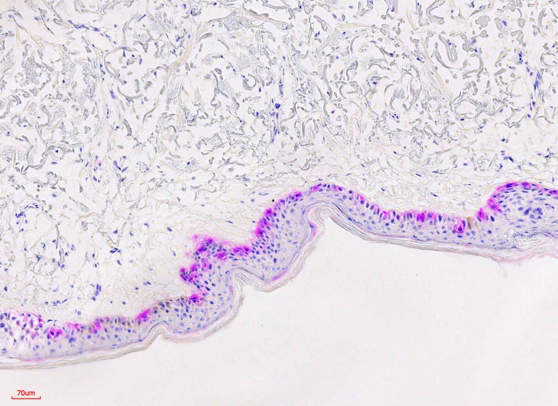 Novodiax magenta chromogen for IHC on MART-1