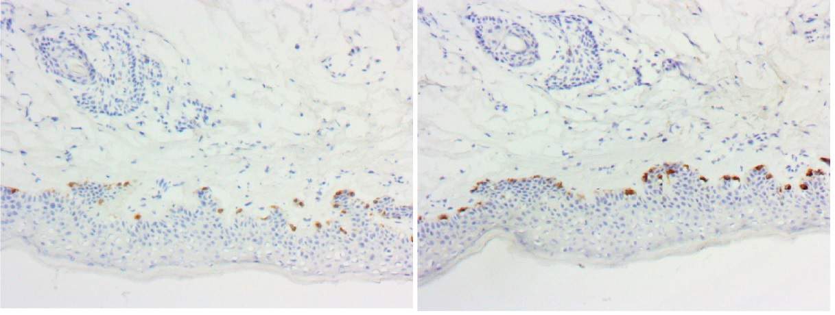 2020 Melanoma Mart-1-ihc Enhancer W-out (L) and With (R) ihcDirect Mart-1(L), with ihc Enhancer(R)