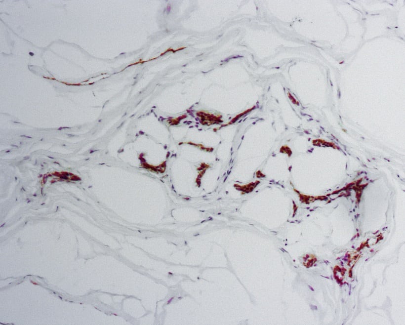 breast ca N00050, p-podoplanin 200331, 30 ug, 4-20-2020, 9B_size_reduced