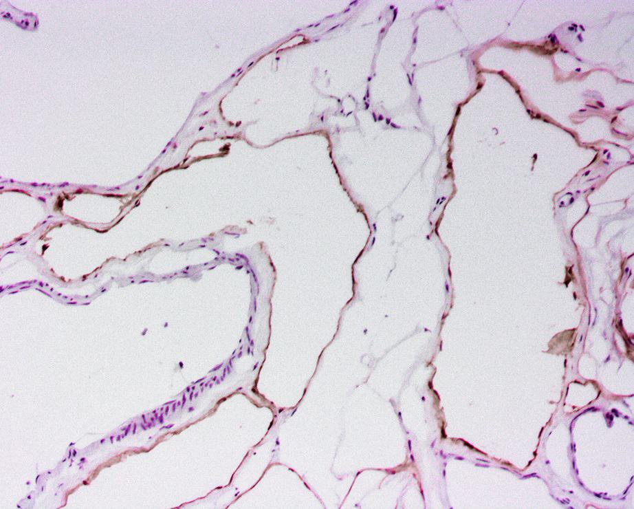 breast ca N00054, p-podoplanin 200331, 30 ug, 4-20-2020, 11B_size_reduced