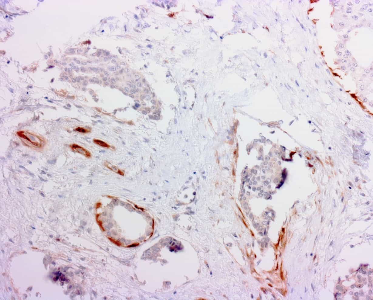 breast ca S13-21602-3B, p-Calponin, lot 150335, 1 to 5, EDTA, 2-step protocol, 1-19-2021, -13_size_reduced