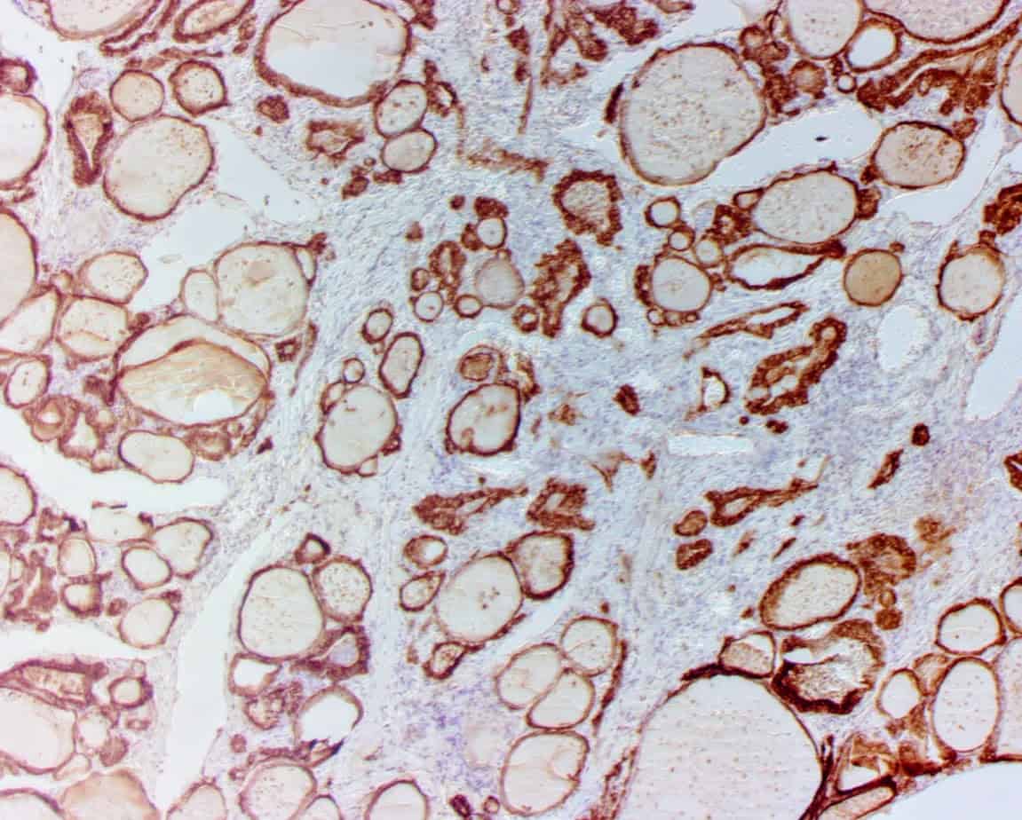QSX TPO (Clone C129) on FFPE thyroid cancer