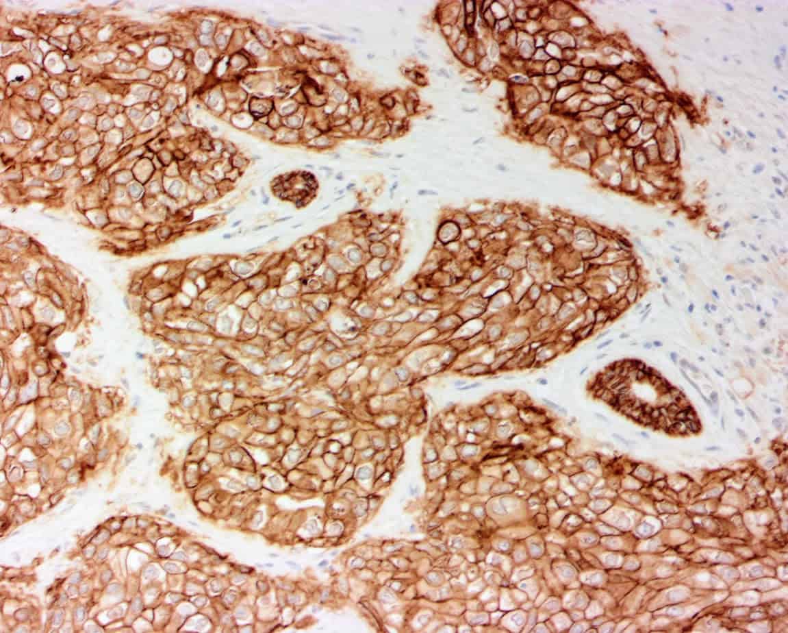 QSX Trop2 (Clone R1011) on FFPE Breast Ca with Buffer H HIER