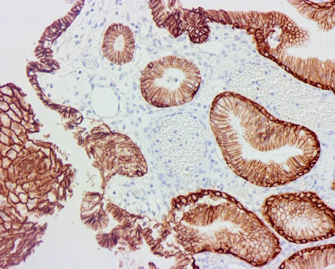 QSX Trop2 (Clone R1011) on FFPE Cervical Ca