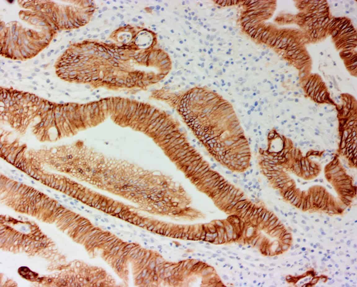 QSX Trop2 (Clone R1011) on FFPE pancreatic ca with Buffer H HIER
