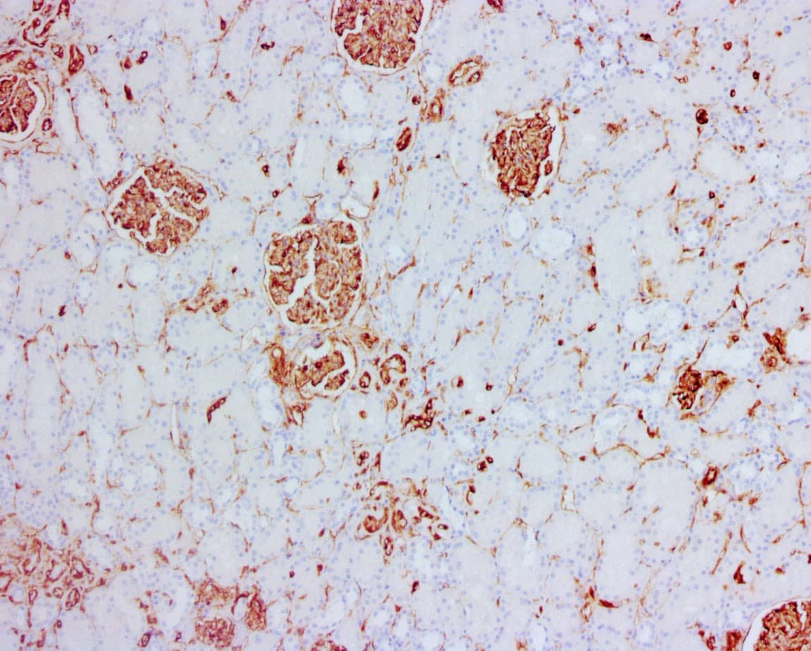 QSX Vimentin (Clone R289) on FFPE kidney ca