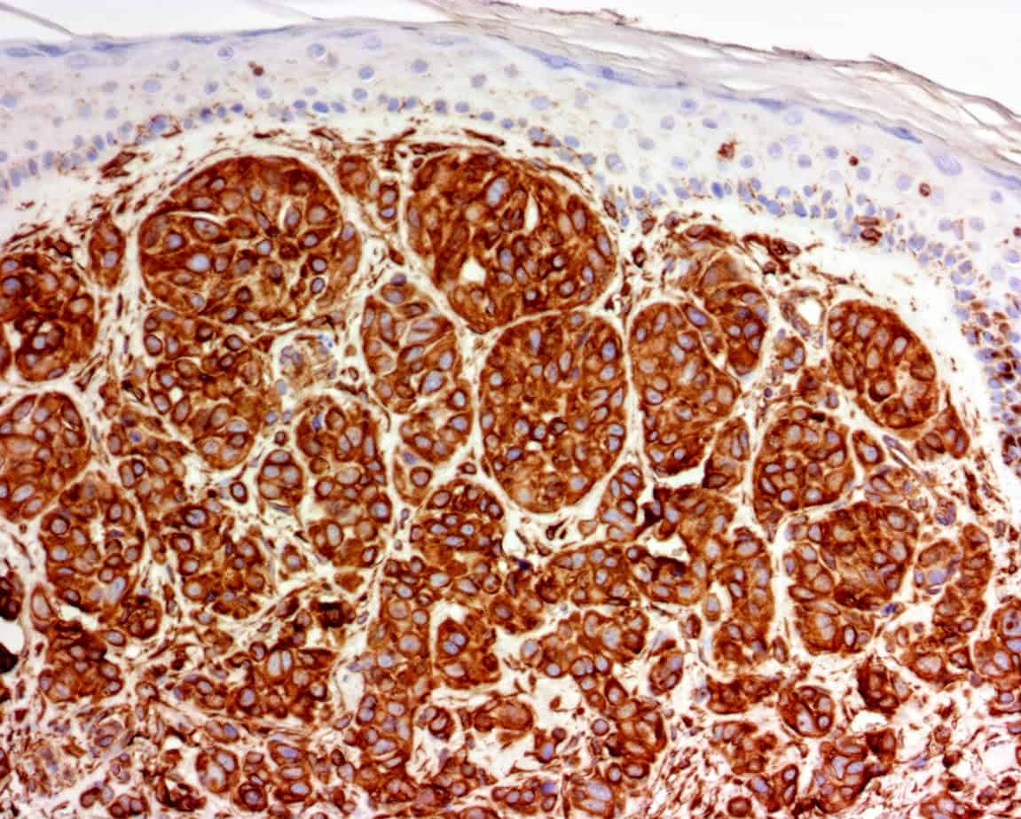 QSX Vimentin (Clone R289) on FFPE melanoma