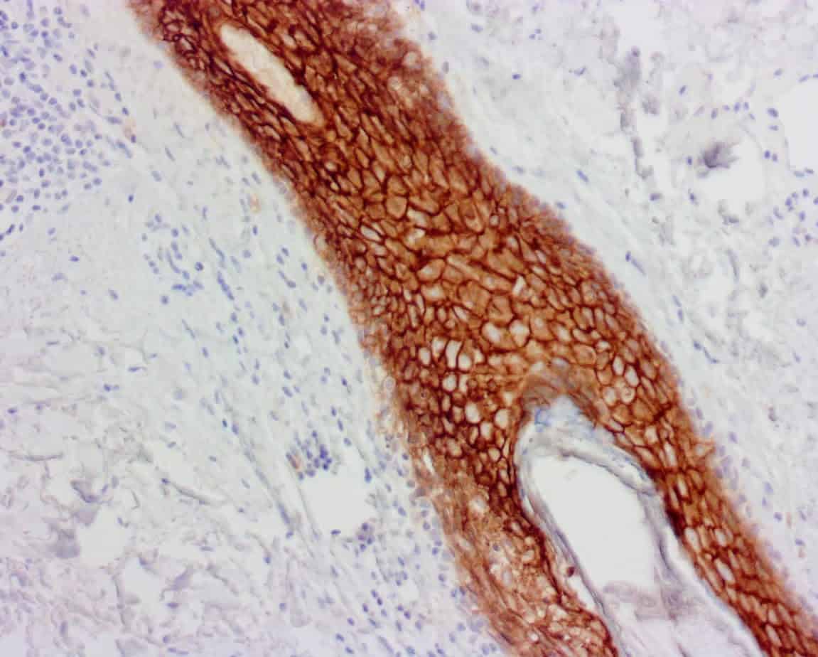 ihcDirect Trop2 (Clone R1011) on FFPE Oral SCC