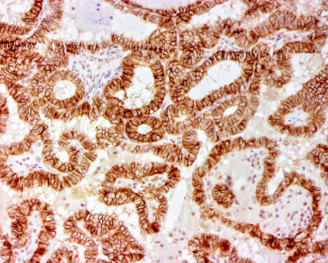 ihcDirect Trop2 (Clone R1011) on FFPE thyroid ca with Buffer L HIER
