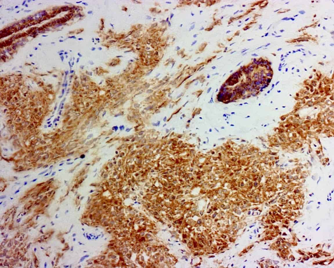 ihcDirect Trop2 (Clone R1011) on frozen breast ca