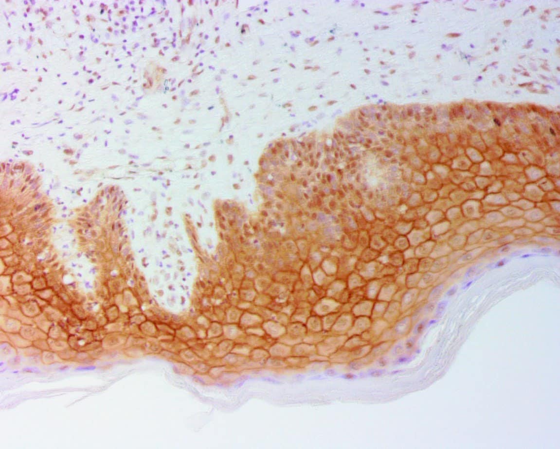 ihcDirect Trop2 (Clone R1011) on skin BCC with Buffer H HIER