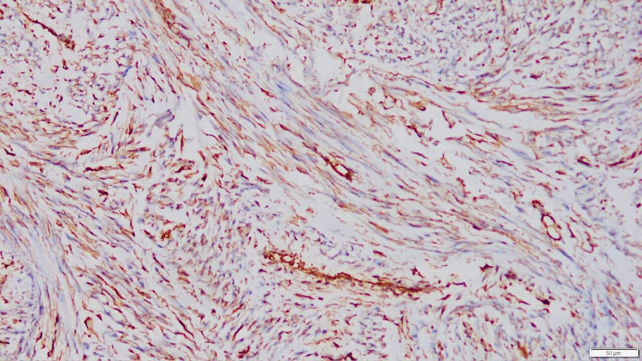 ihcDirect Vimentin (Clone (R289) on frozen uterus