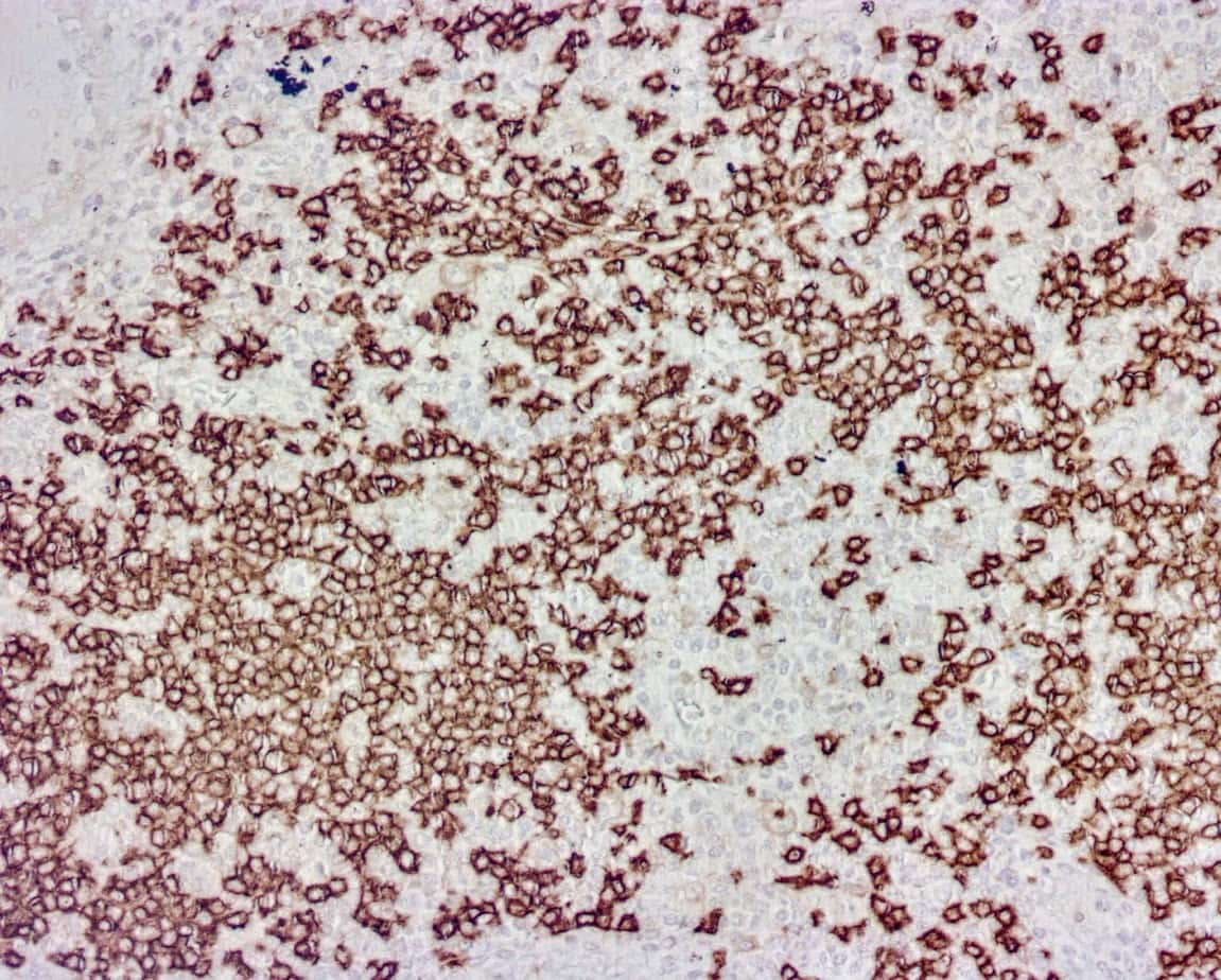 CD20 (Clone R272) on FFPE Hodkin's Lymphoma