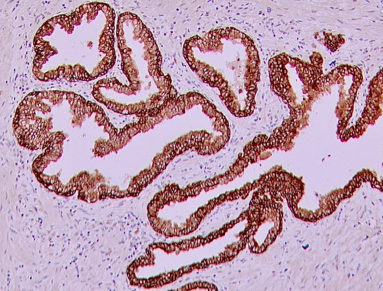 QSX AE1-AE3 on FFPE prostate cancer