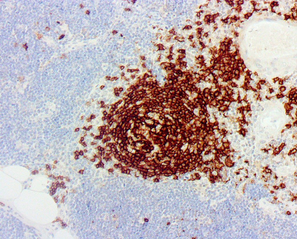 QSX CD20 (Clone R272) on FFPE lymph node