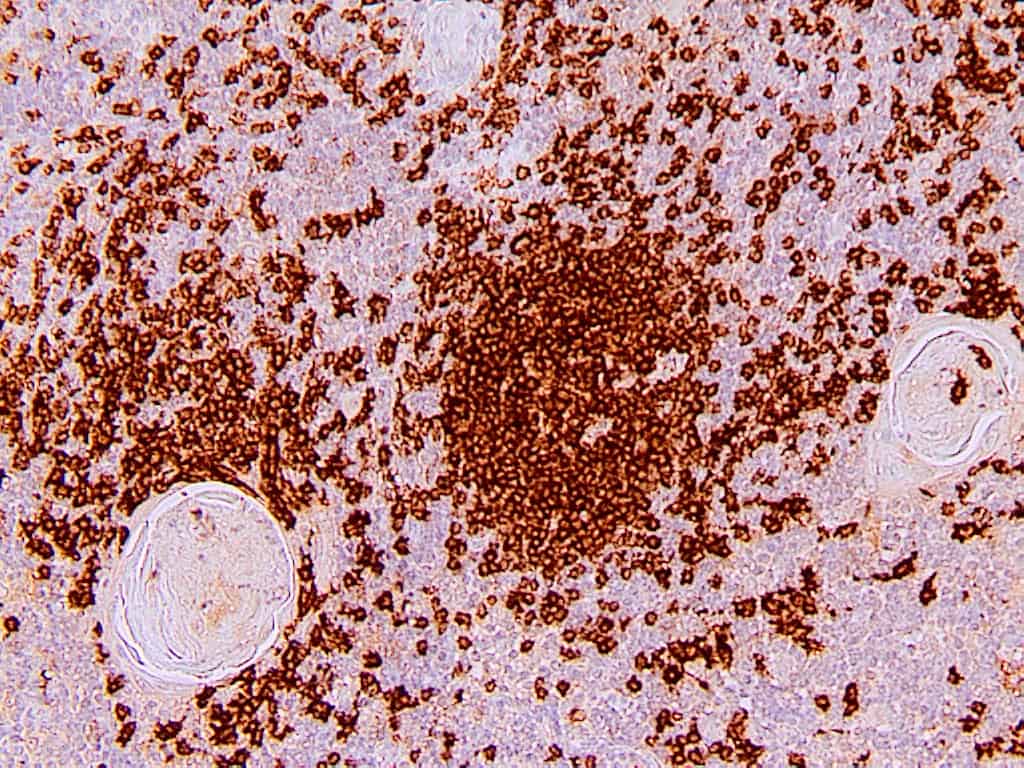 QSX CD20 (Clone R272) on FFPE tonsil
