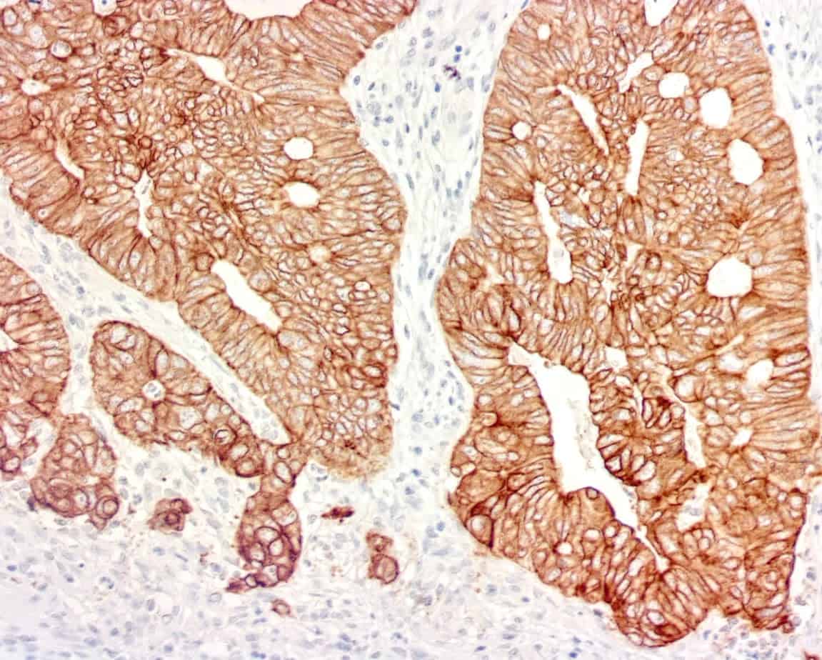 QSX CK19 (Clone R1002) on FFPE Colon Ca