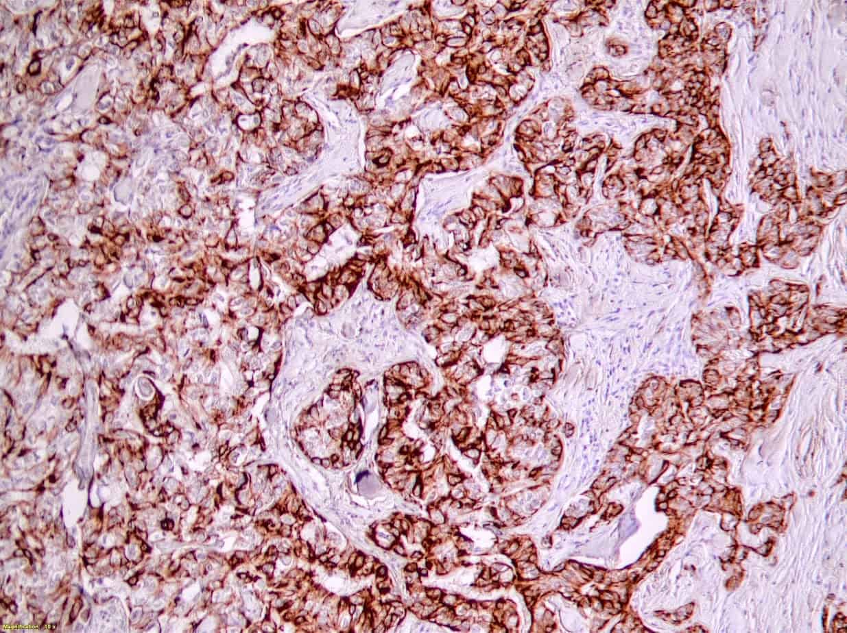 QSX CK5 (Clone R226) on FFPE Breast Cancer