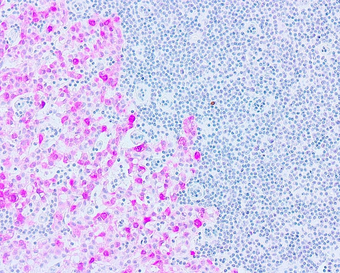 QSX CK7 (Clone R284) on FFPE Breast Ca in Sentinel Lymph Node, Buffer L