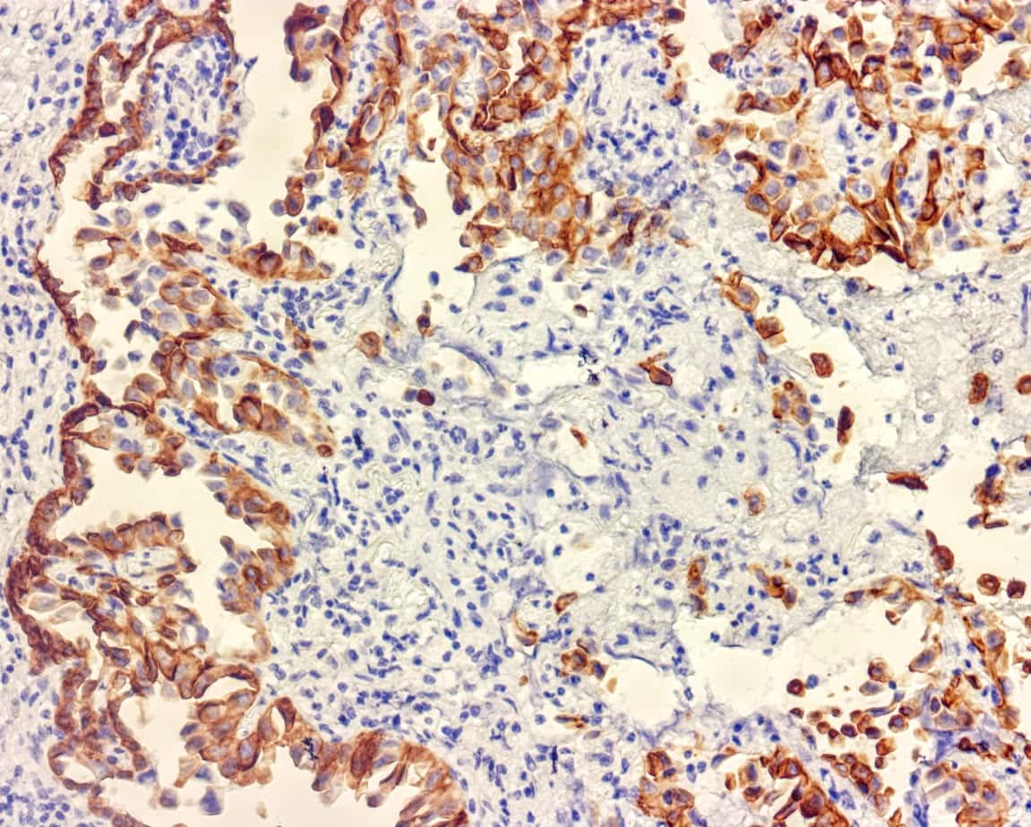 QSX CK7 (Clone R284) on FFPE Lung Cancer