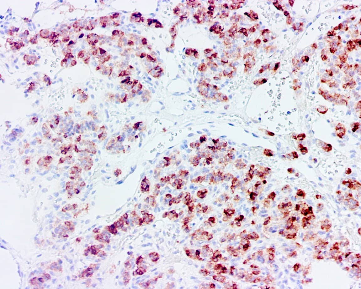QSX Chromogranin A (Clone R1004) on FFPE Pancreatic Ca with Buffer L