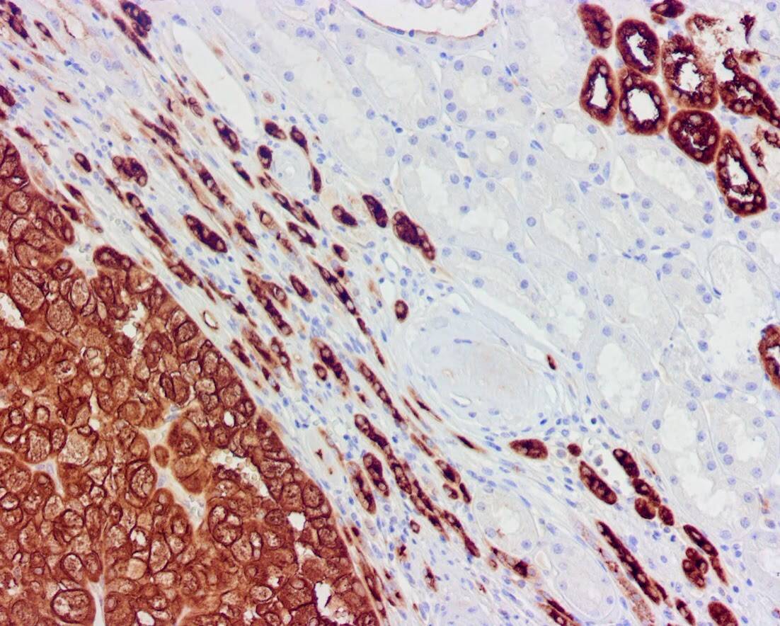 QSX EMA (Clone C137) on FFPE Renal Ca