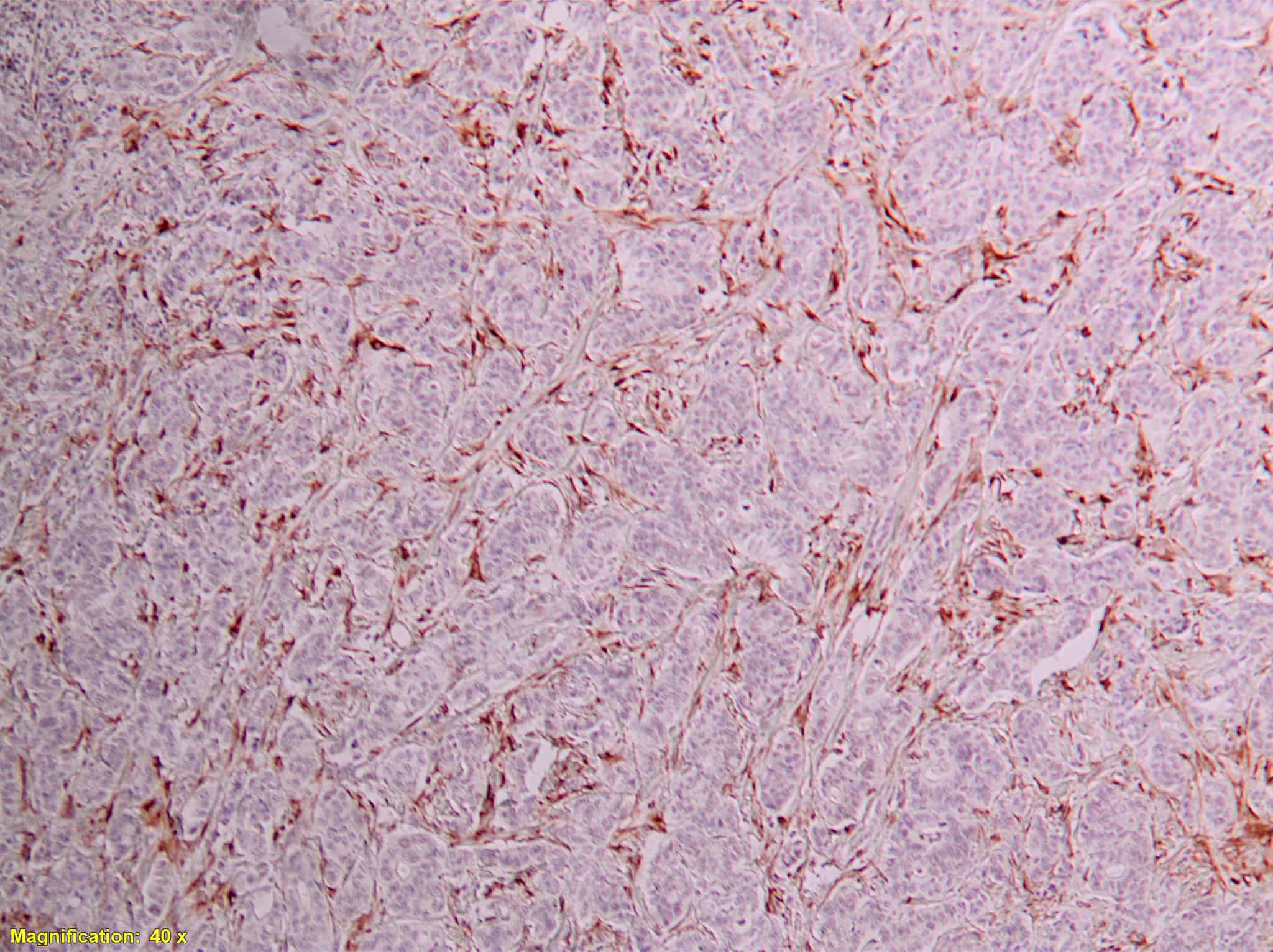 QSX GFAP on FFPE stomach cancer