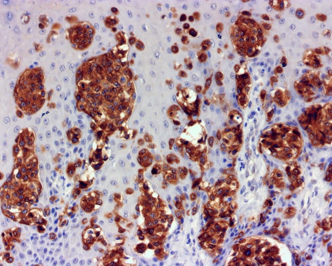 QSX Mart1 (Clone A103) on FFPE melanoma