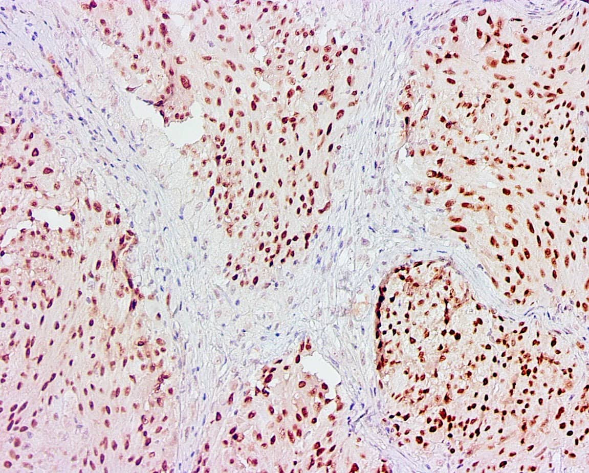 QSX PRAME (Clone R1009) on FFPE melanoma with HIEnD treatment