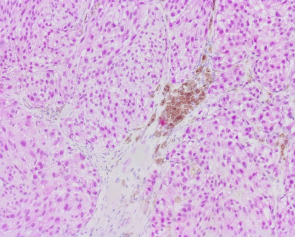 QSX PRAME (Clone R1009) on FFPE melanoma with magenta chromogen