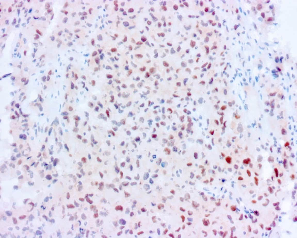 QSX PRAME (Clone R1009) on FFPE salivary gland ca