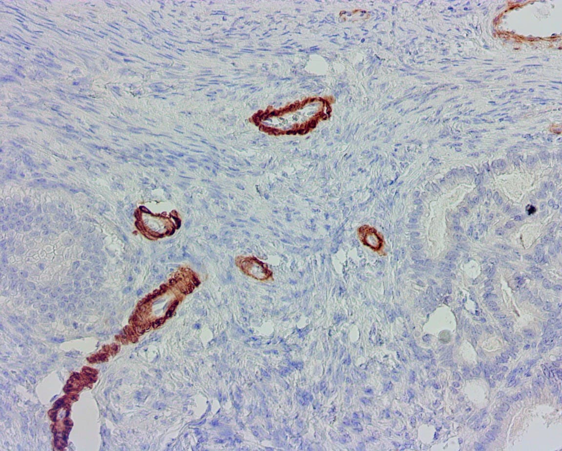 QSX SMMHC (Clone SMMS-1) on FFPE Uterus Ca