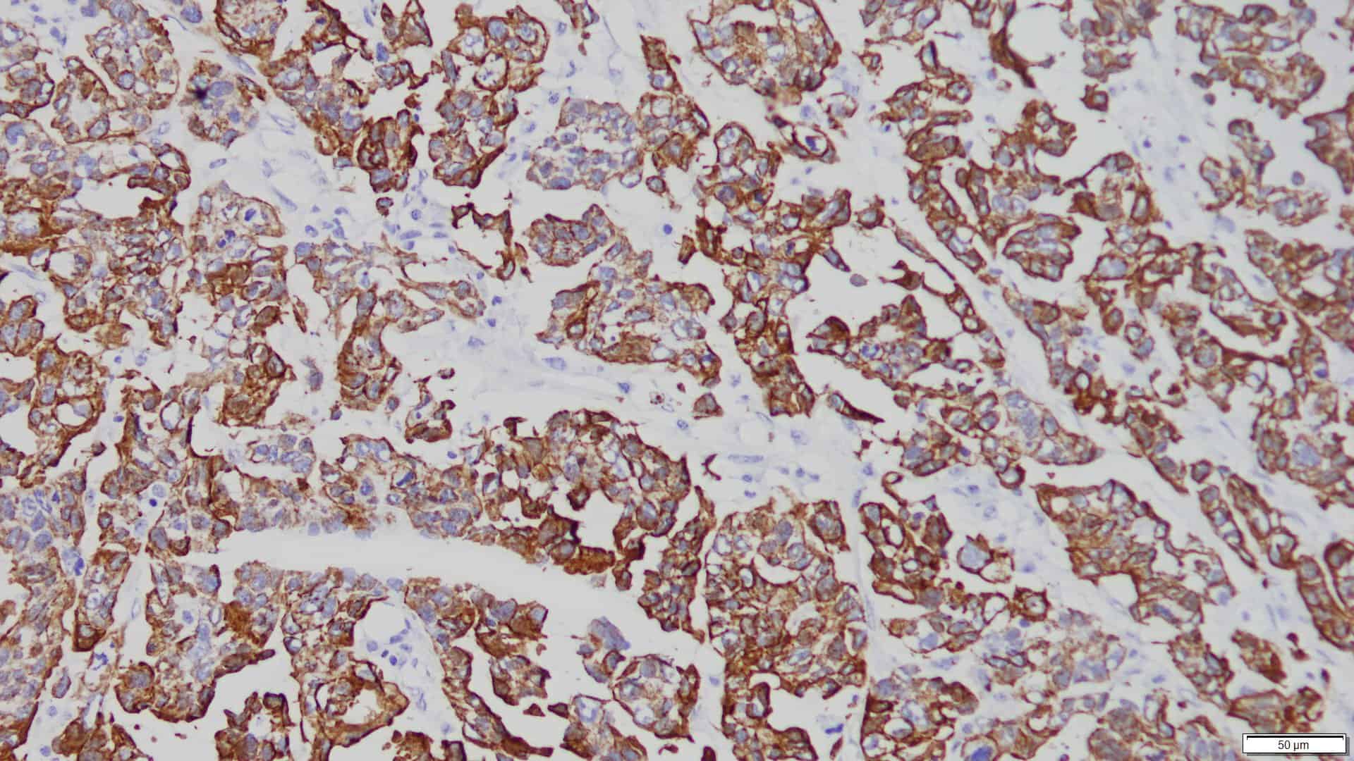 ihcDirect CK19 (Clone R1002) on frozen Ovarian Ca
