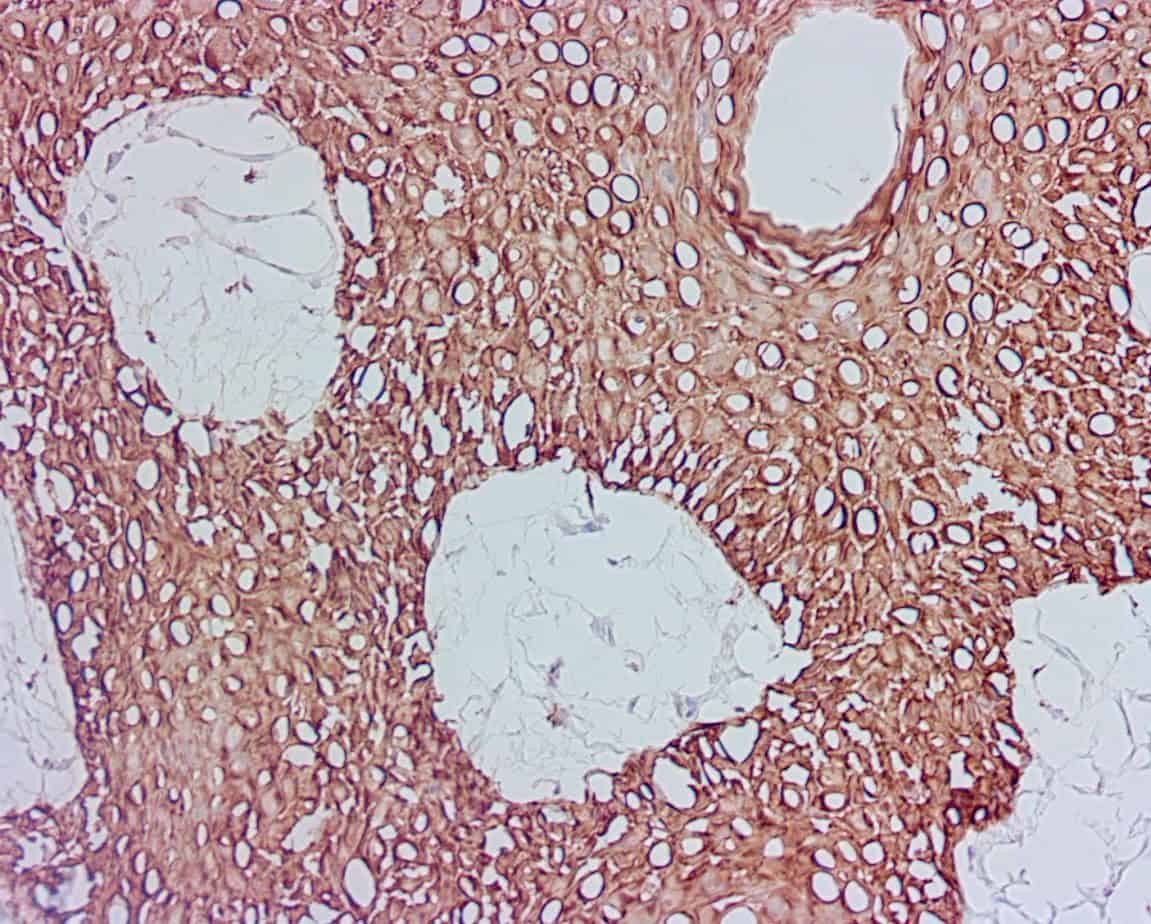 ihcDirect CK5 (Clone R226) on frozen Skin SCC