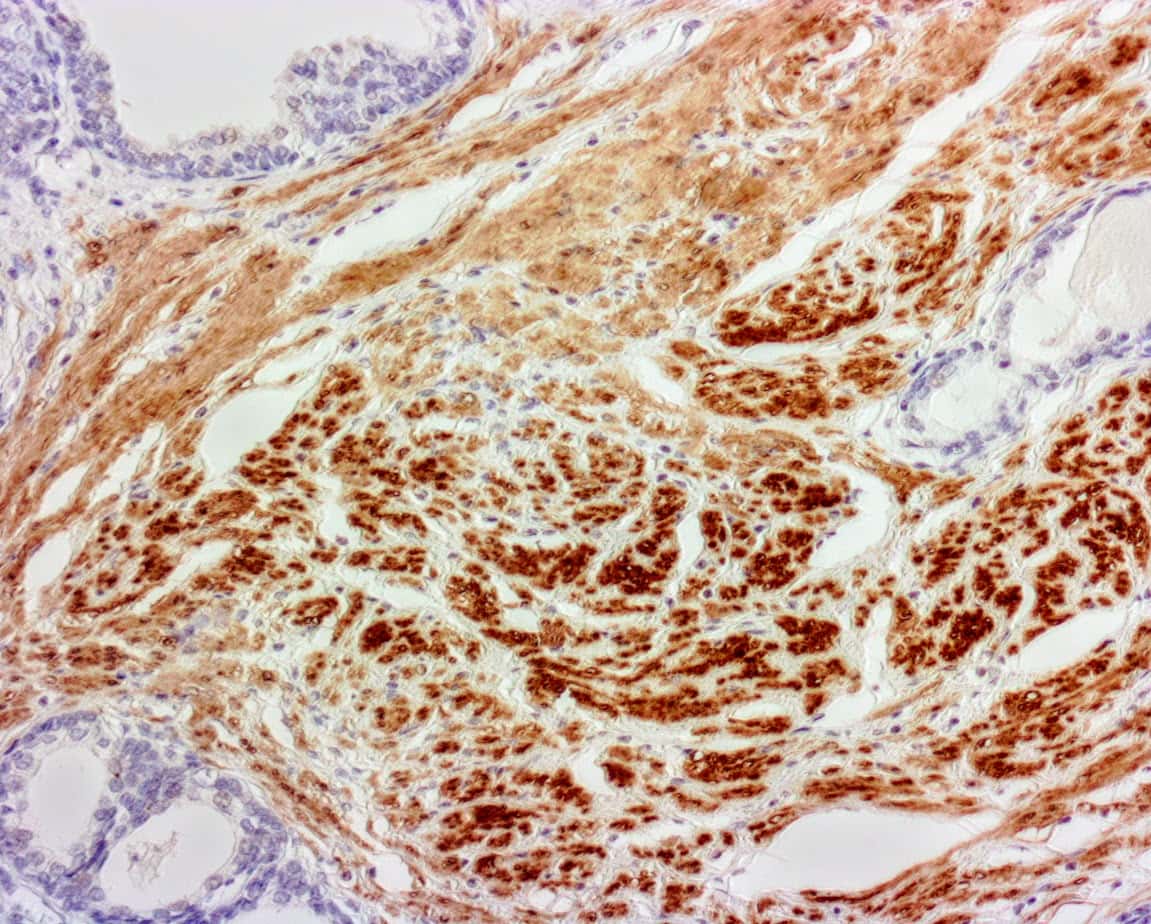 ihcDirect Calponin (Clone C126) on FFPE Prostate Ca