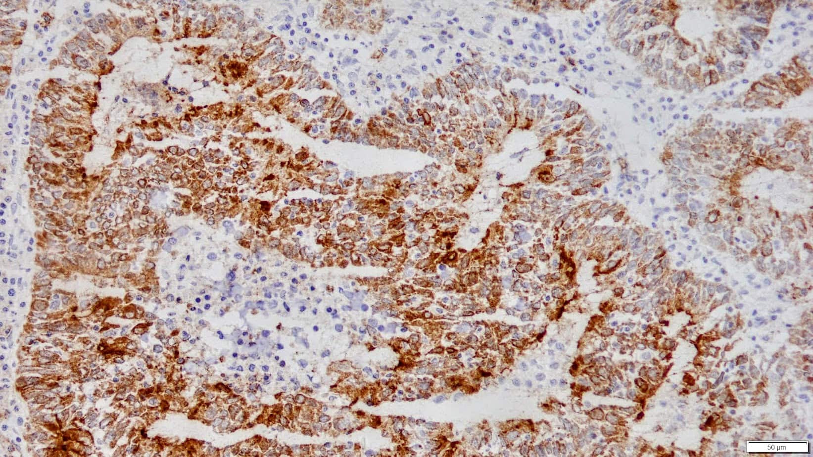 ihcDirect EMA (Clone 137) on frozen endometrial ca