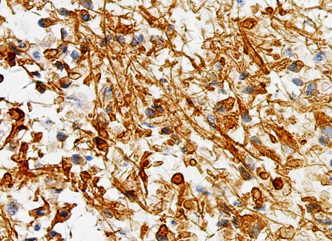 ihcDirect GFAP (Clone R246) on frozen glioma