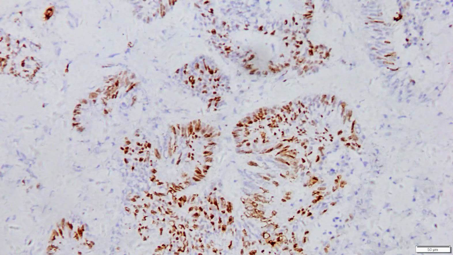 ihcDirect Ki67 (Clone R360) on frozen ovarian ca