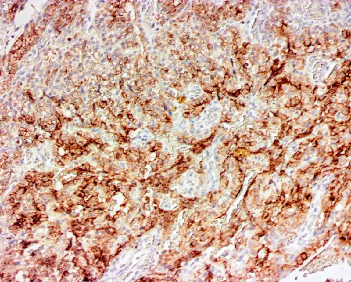 ihcDirect PTH (Clone C123) on parathyroid adenoma